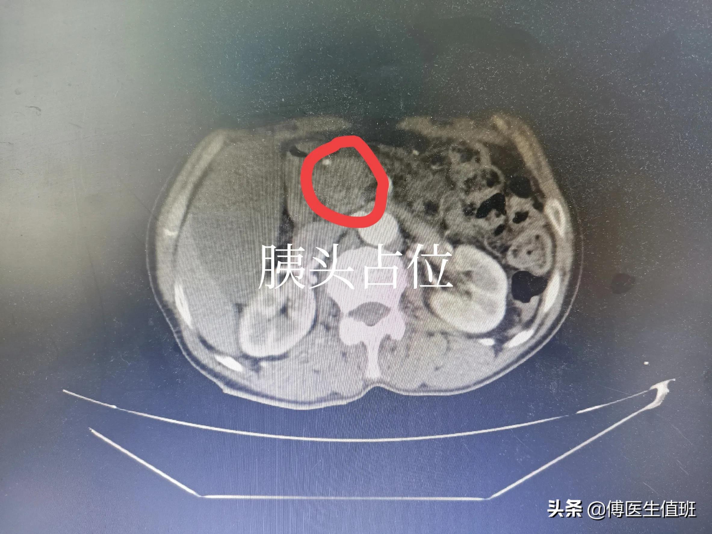 男子吃鸡后腹胀、腹泻，医院检查发现转氨酶升高，医生：胰腺肿瘤