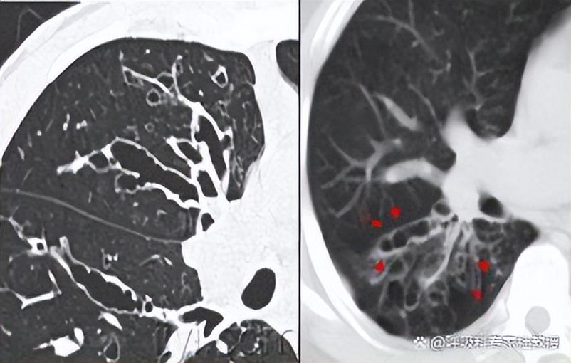1分钟教你看懂ct报告单,一分钟自测支气管炎