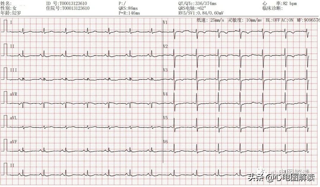 肢体导联低电压倾向严不严重,啥叫肢体导联低电压