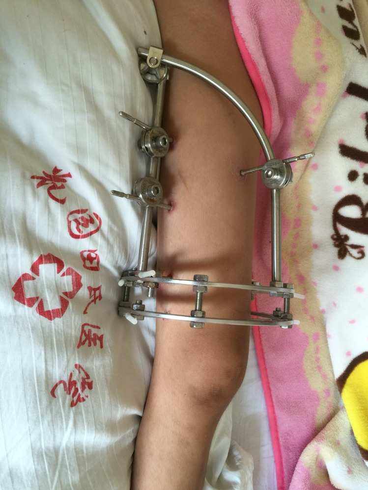 儿童股骨干粉碎性骨折对位不太好,儿童股骨干骨折石膏固定