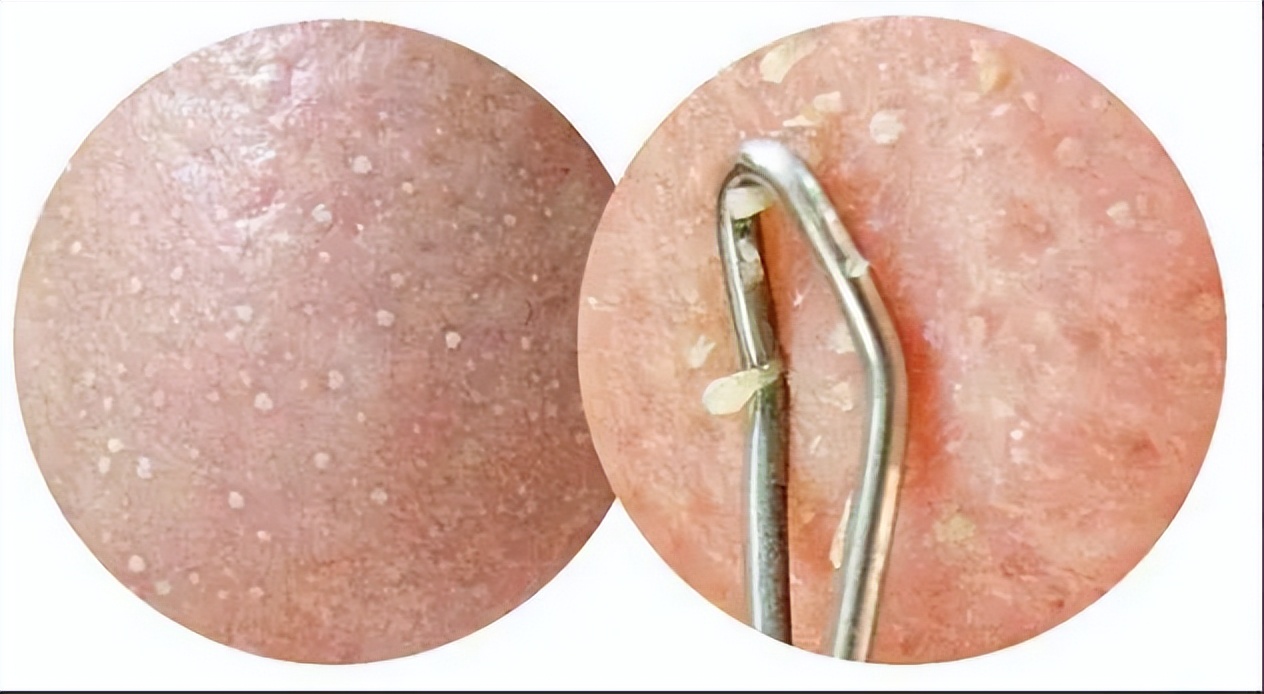 脸上挤出来硬硬的白粒,脸上白小米粒怎么回事