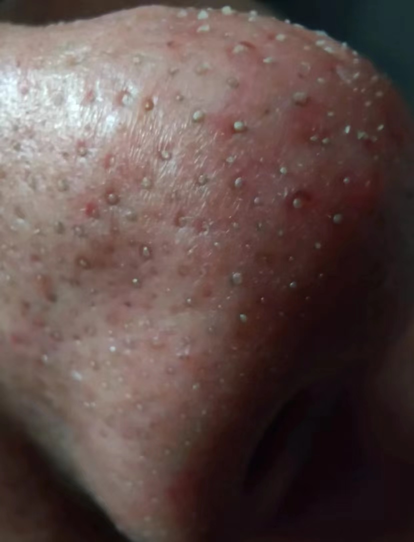 去除鼻子黑头收缩毛孔小妙招,鼻子黑头毛孔大抹什么药膏