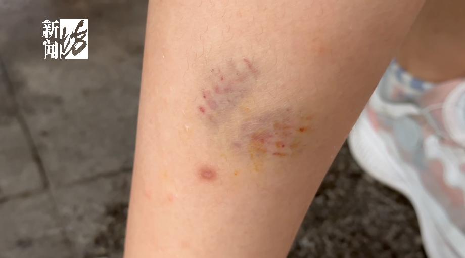 女子小区被狗咬,小区狗咬到人报警警察怎么处理呢