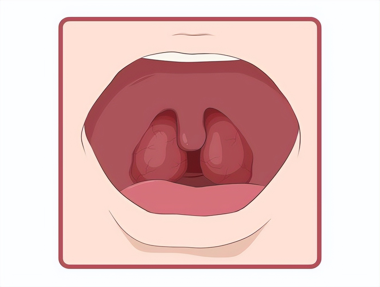 化脓性扁桃体炎中医怎么治,儿童化脓性扁桃体炎中医怎么治疗