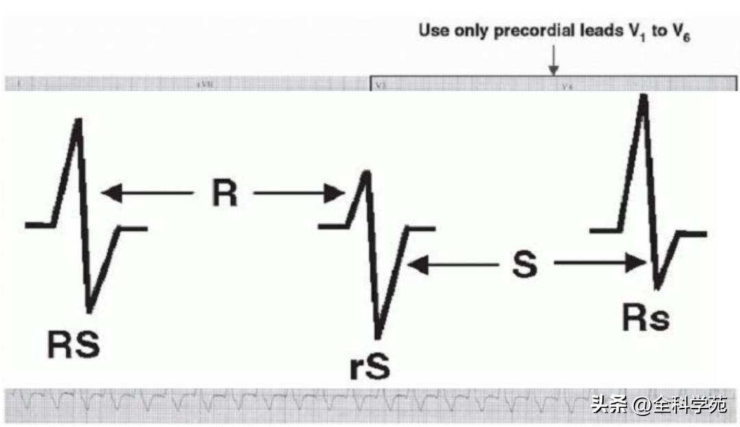 心电图上表现为宽qrs波,心电图中qrs是代表心动过速吗