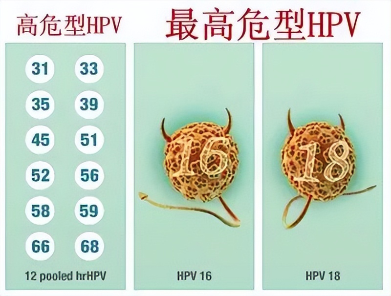 尖锐性湿疣是hpv高危感染吗,尖锐性湿疣和hpv哪个更严重