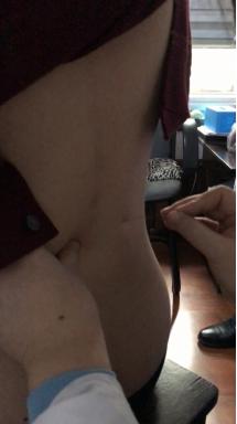 腰椎侧弯腰痛吃什么药,臀肌筋膜炎导致腰椎侧弯