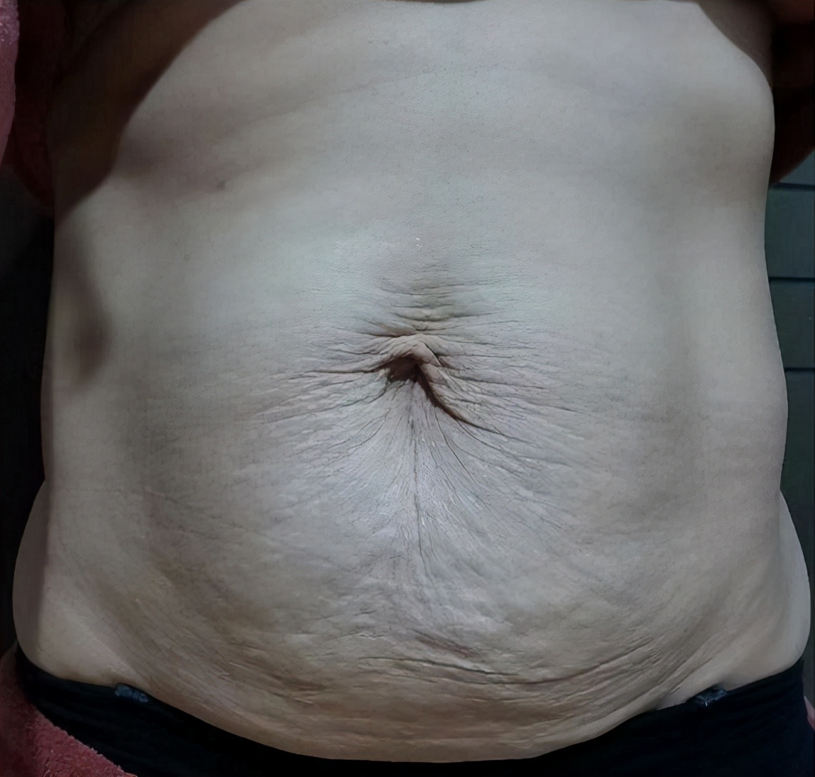 余文林：产后变胖腹壁松弛下垂怎么办？