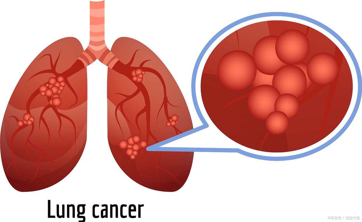 肺癌晚期呼吸困难会引起心衰吗,肺癌晚期胸积水呼吸困难怎么办