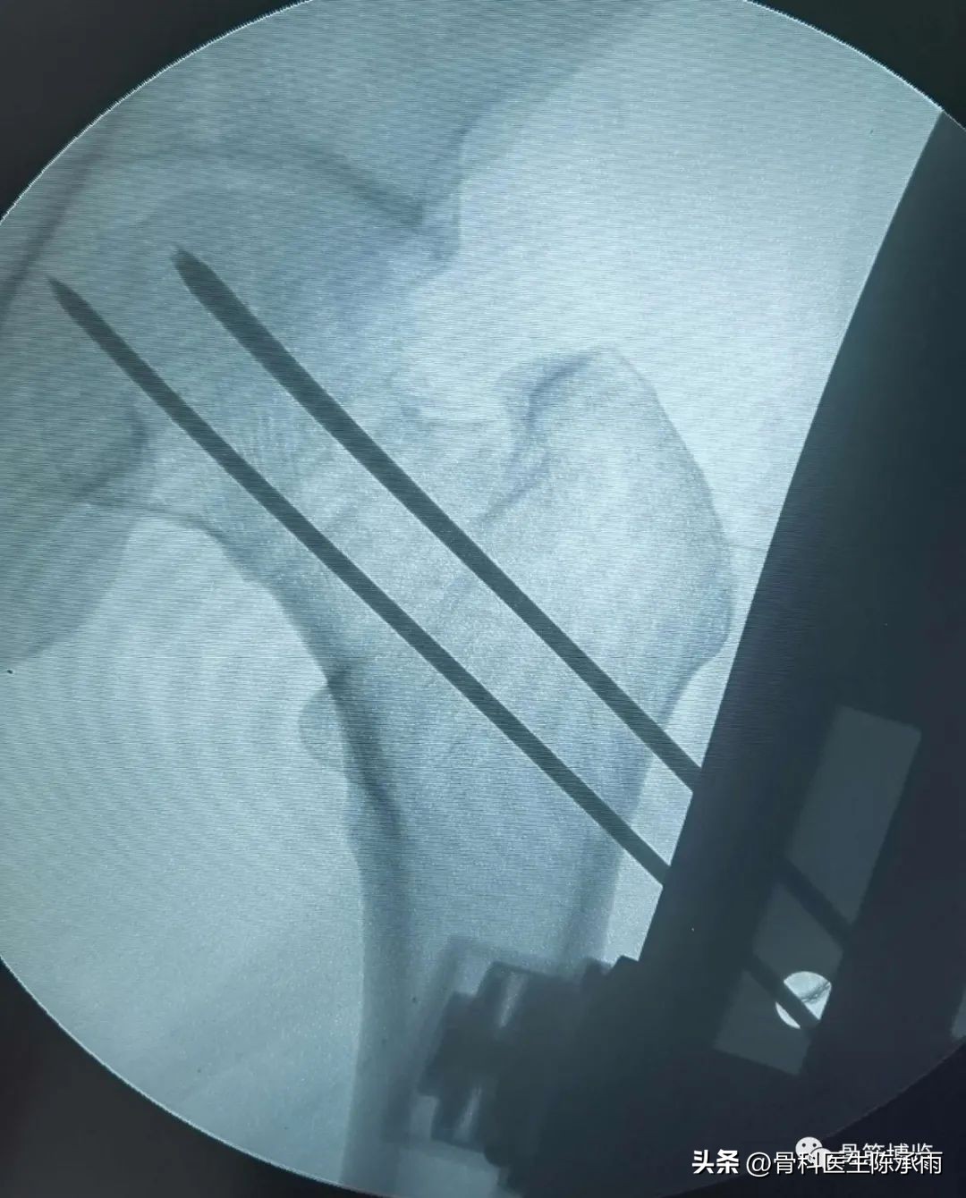 股骨颈闭合复位内固定术后护理,股骨颈骨折闭合复位的技巧