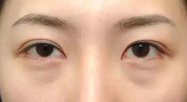 眼袋大怎么办如何解决快又好,眼袋大很显老小妙招