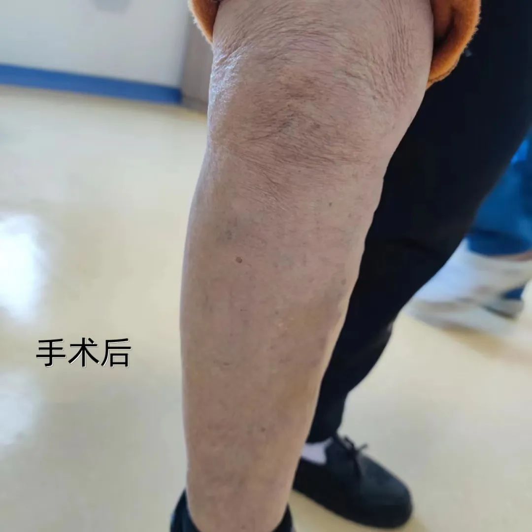 微创无疤！沣东院区完成首例腔内注射硬化剂微创治疗大隐静脉曲张