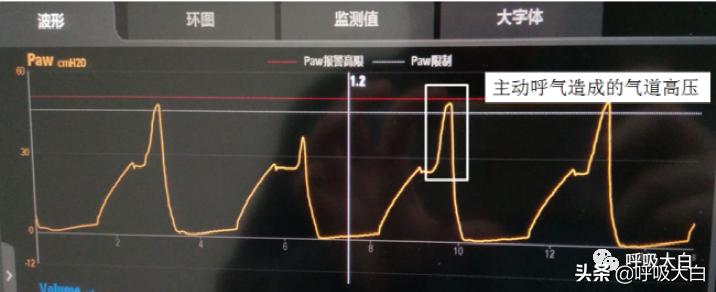 呼吸机设置：呼吸频率+吸呼比