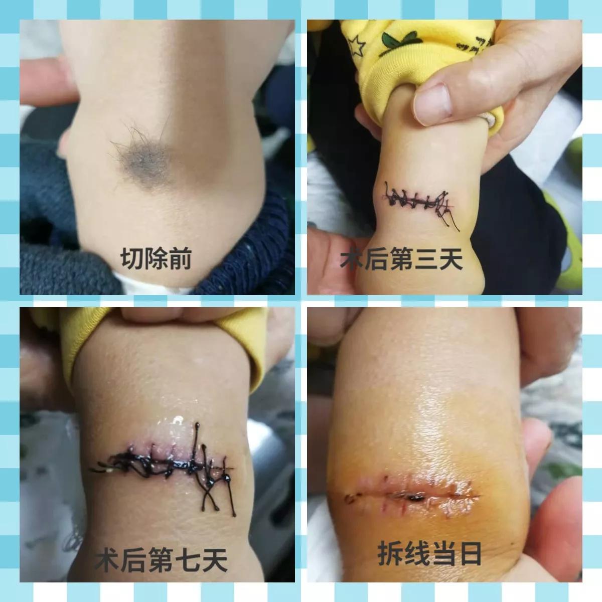 儿童黑毛痣术后图片,小孩黑毛痣切除一年恢复图片