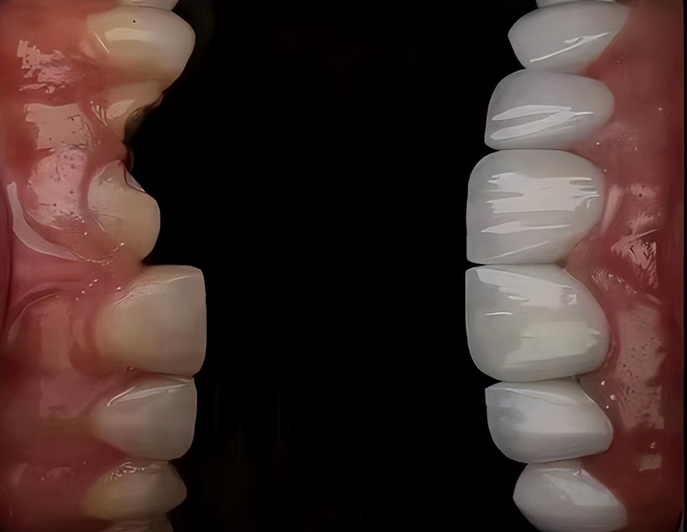 不同瓷块的贴面,不同瓷贴面的对比图