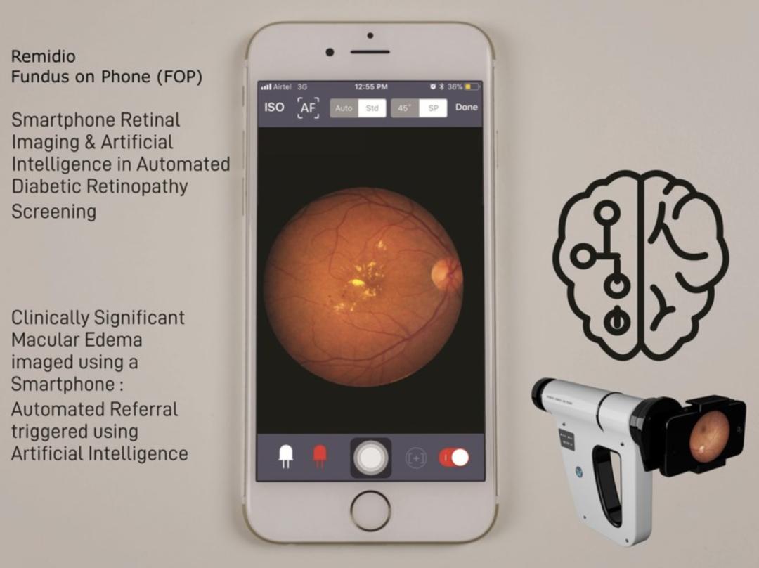 Remidio：手机+AI也能成为医疗器械潜力股｜前哨