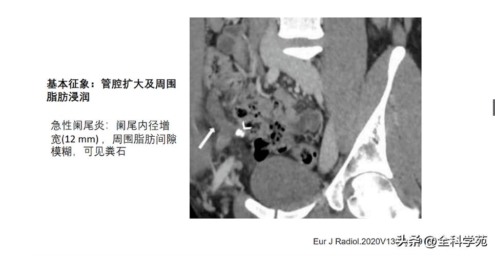 阑尾炎的讲解,关于阑尾炎的讨论总结
