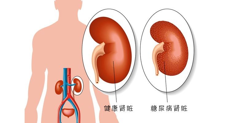 降糖药瑞格列奈,降糖药中促胰岛素分泌的药有哪些