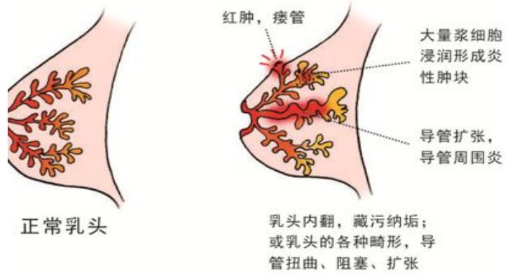 河北石家庄治疗乳腺炎最好的医院,河北工程大学医院乳腺科电话