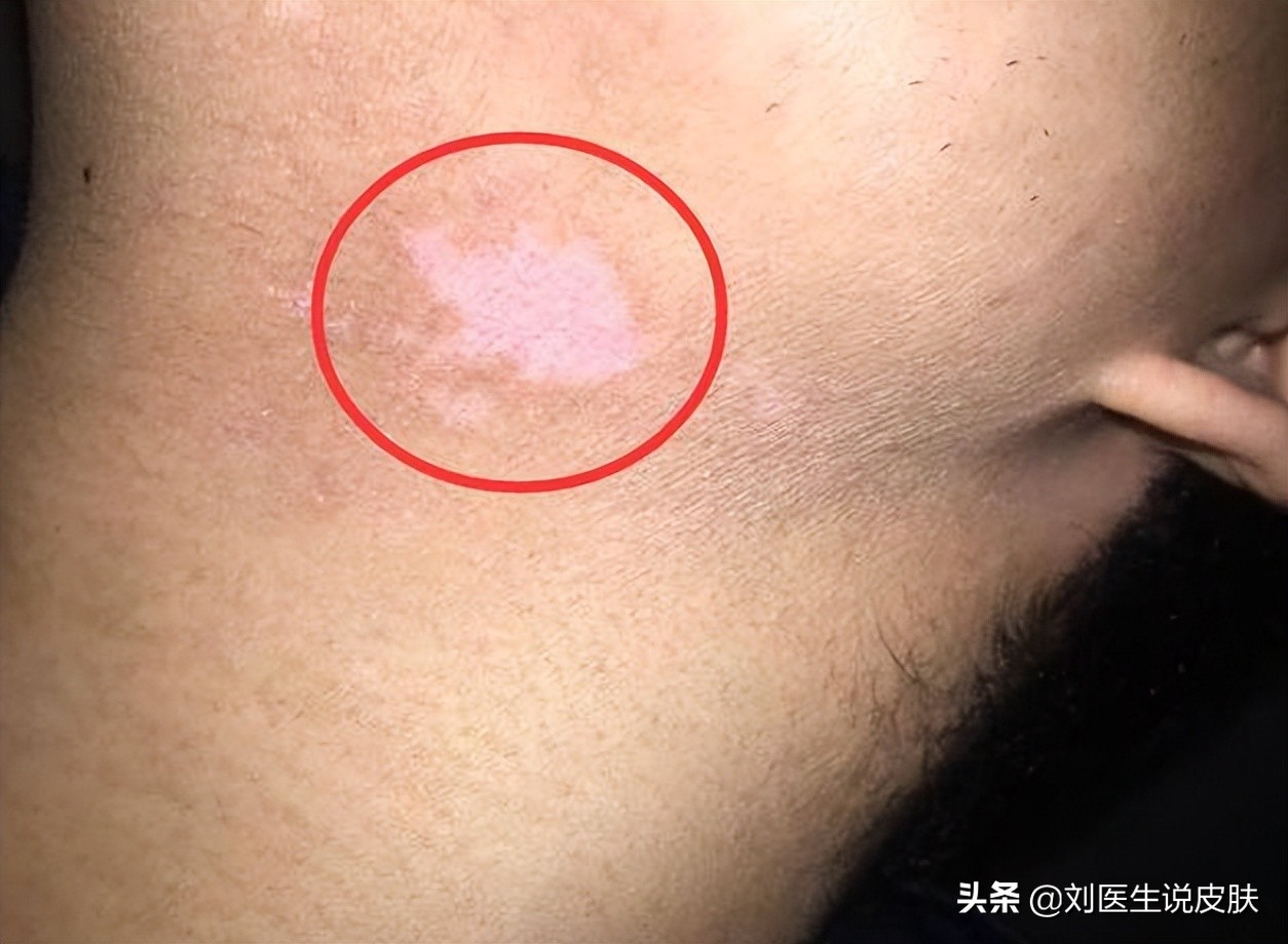 晕痣型白癜风初期和中期的区别,黑痣型白癜风怎么治