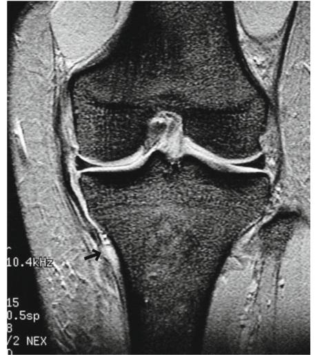 内侧副韧带损伤自测图,mcl内侧副韧带