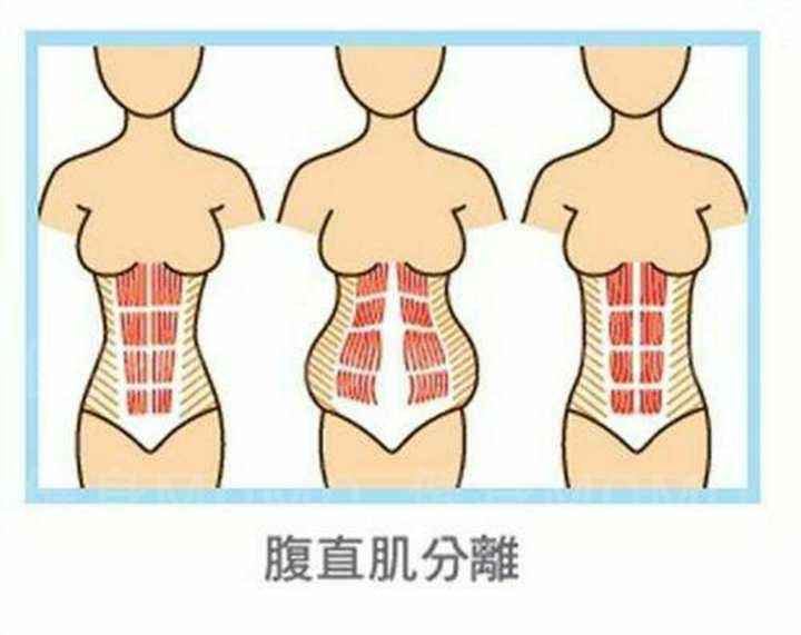 腹直肌分离如何做治疗,腹直肌分离严重怎么治疗