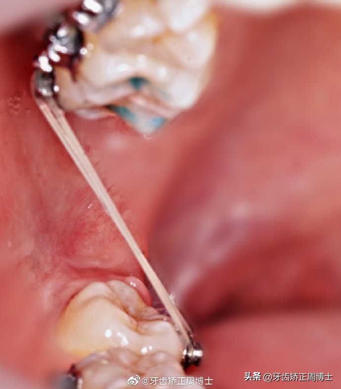 早期矫正下颌往前伸怎么纠正,改善正畸后锁颌方法