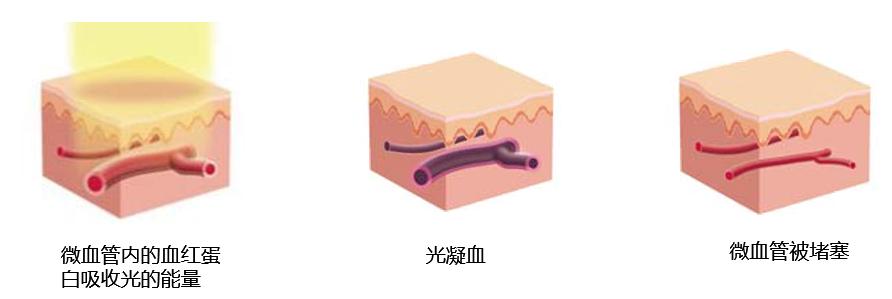 做祛红激光治疗疤痕后的护理,pdl激光治疗红血丝效果好吗