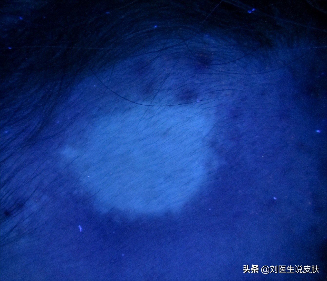 额头白斑，生姜涂擦后扩散怎么办？医生1个方案，治白又快又好