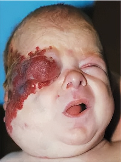 治疗婴幼儿血管瘤的特效药物——盐酸普萘洛尔口服液上市