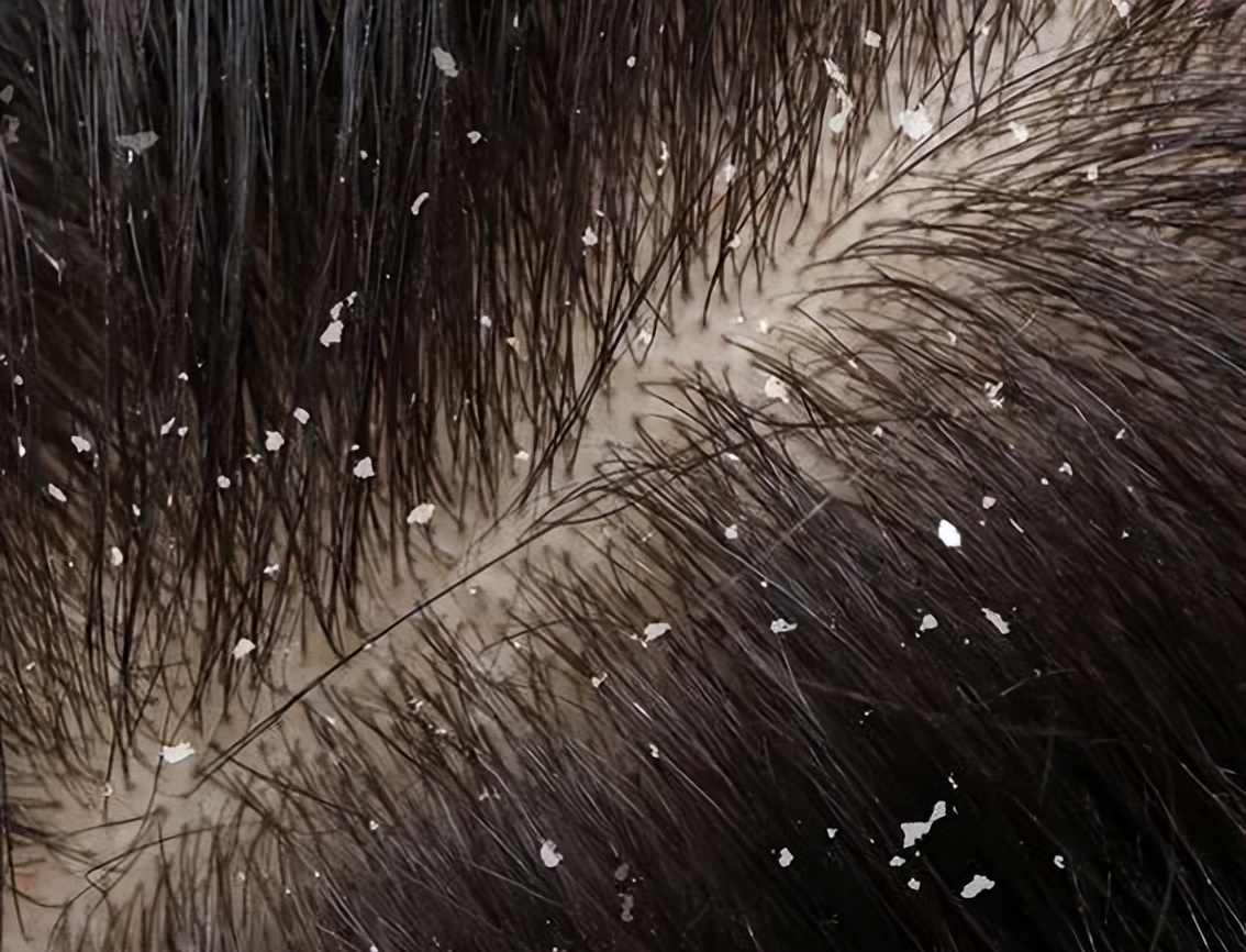 头皮发痒有头屑是什么原因,头皮发痒头屑多的原因和解决方法