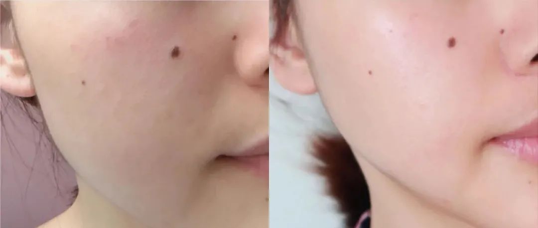 科颜氏美白淡斑精华去痘印,科颜氏美白淡斑精华液去痘印