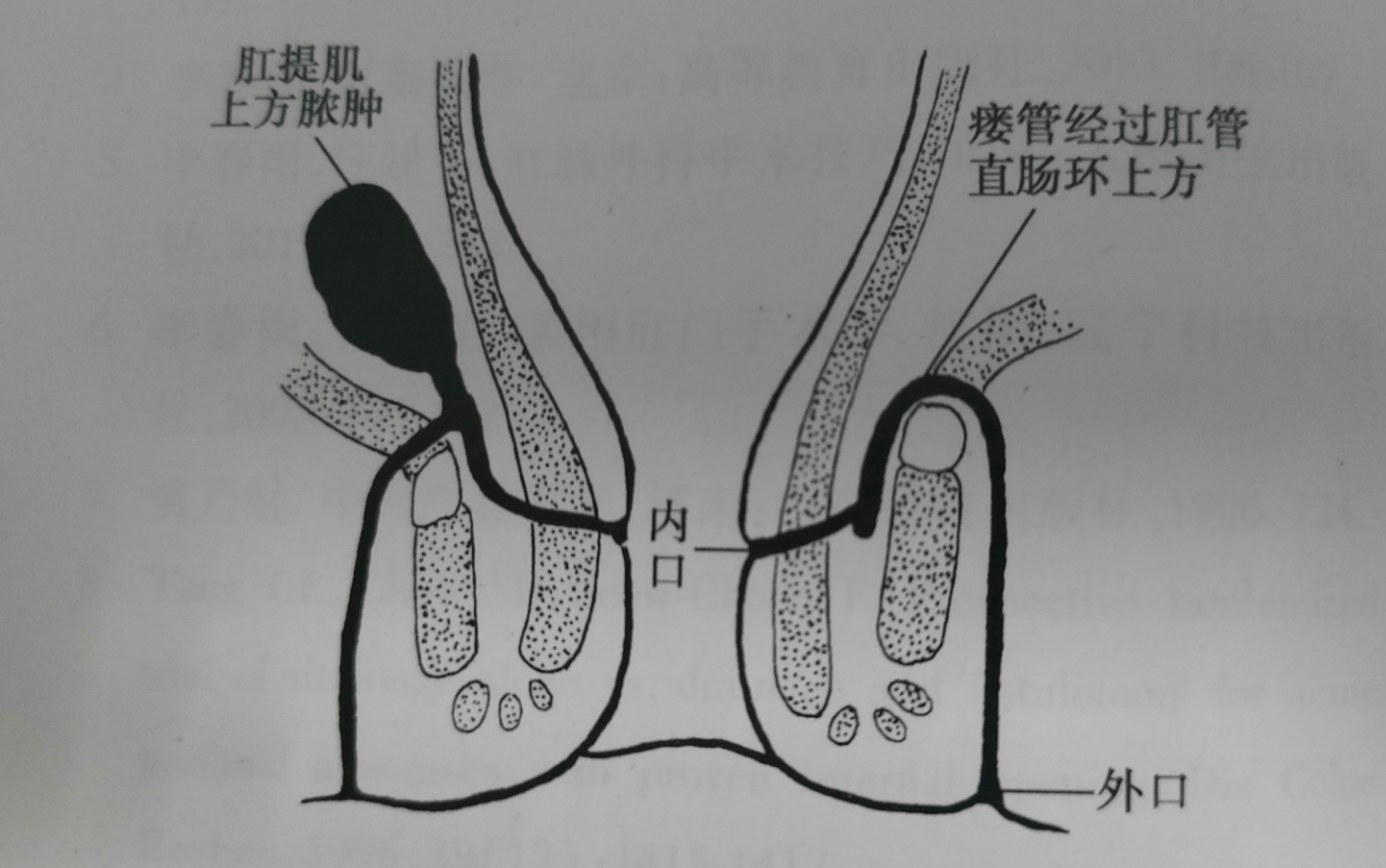 同样是肛瘘,为什么别人术后2天就出院,而我术后七天还出不了院