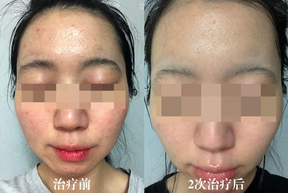 五年的痘坑能用生长因子吗,五年的痘印怎么祛除