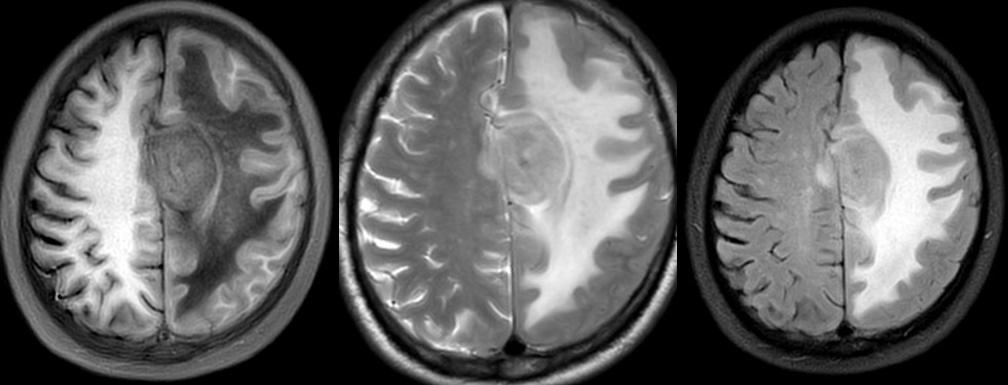 骨软骨瘤mri,颅骨血管瘤mri表现