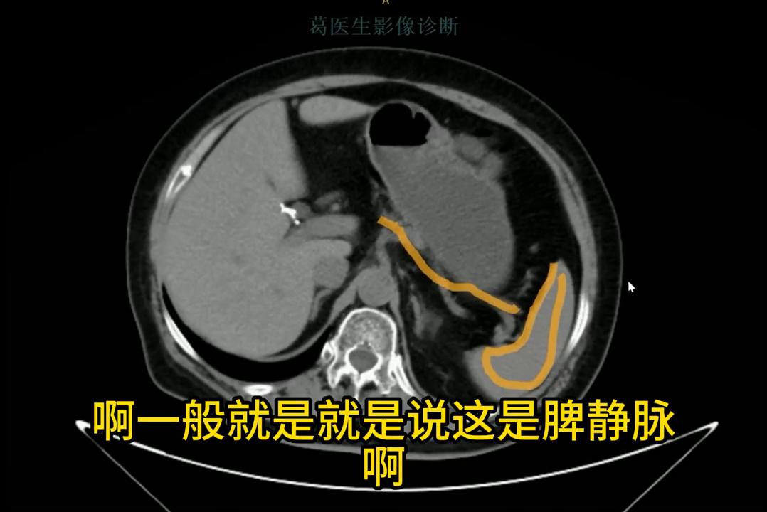 腹部ct影像解剖图谱,腹部ct阑尾影像