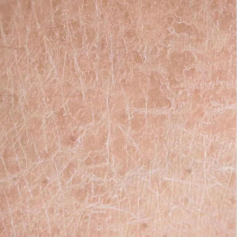 秋冬季节嘴唇干燥起皮怎么办,秋冬身体干燥起皮怎么治