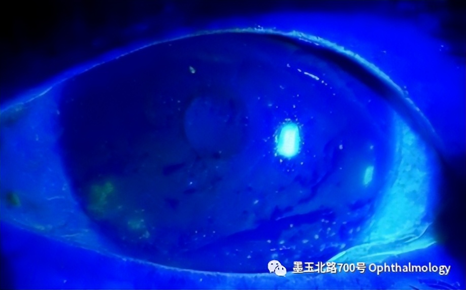 干眼症用什么眼药水,干眼症眼痒的正确解决方法