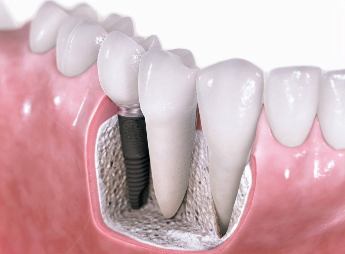 老年人佩戴活动义齿不舒服咋办？这两个问题不能忽视