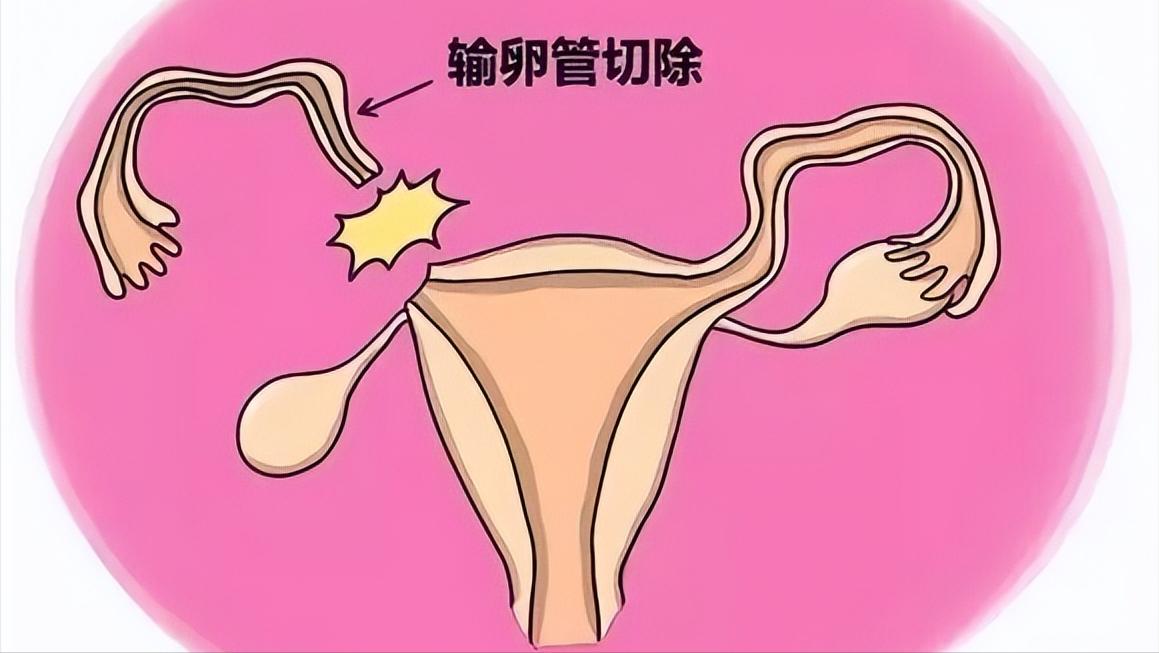 宫外孕都是有什么状况,宫外孕严重吗会有什么样的反应