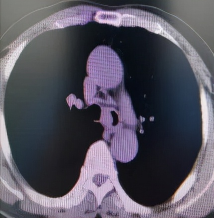 哈医大一院气管镜,哈医大群力呼吸内科