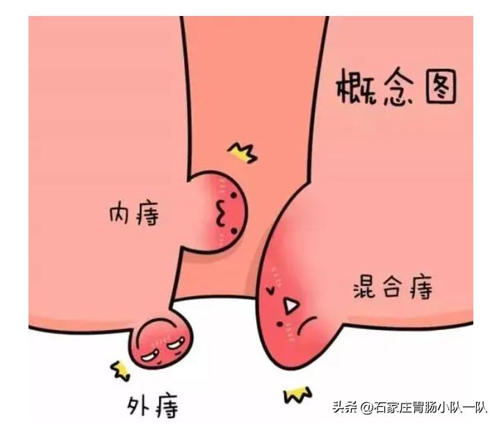 痔疮手术没有那么吓人不要被误导,痔疮手术真有那么可怕