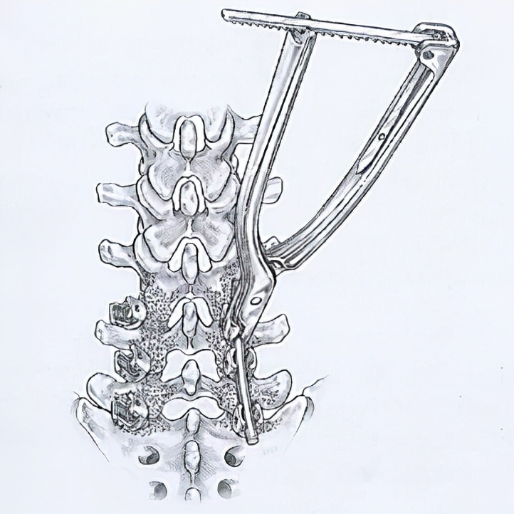 脊柱微创潘医生,脊柱微创初印象