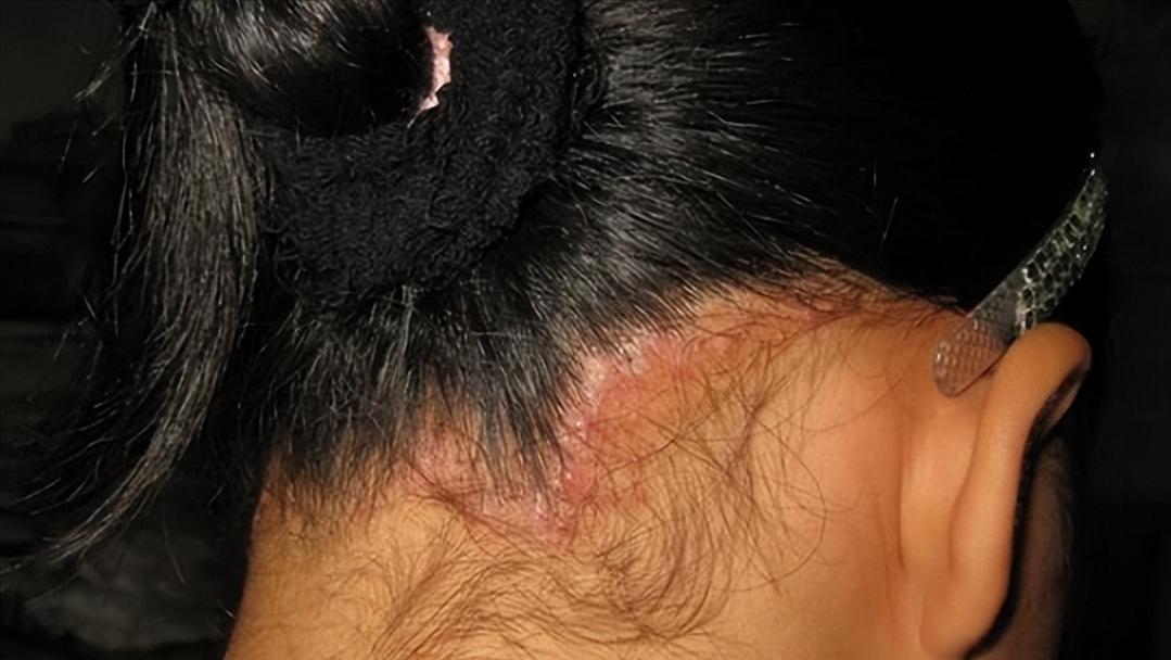 头皮里,老是长疙瘩和脓包,是怎么了?是病吗?告诉你答案