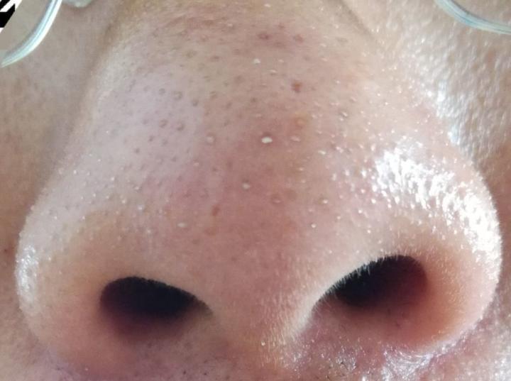 美容院清洁黑头会让毛孔变大吗,黑头拔了毛孔变大会自己愈合吗