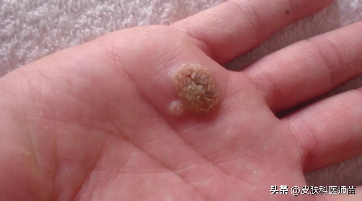 疣和痘痘怎么区分,自己如何鉴别疣