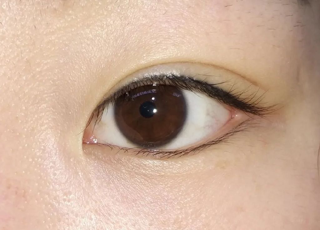 开外眼角优点和缺点,外眼角开的不明显还可以再开吗