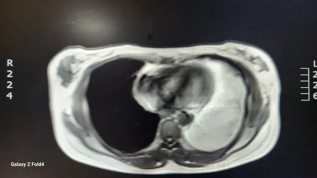 市中心医院胸外科：镜下“小切口”解决纵膈“大问题”