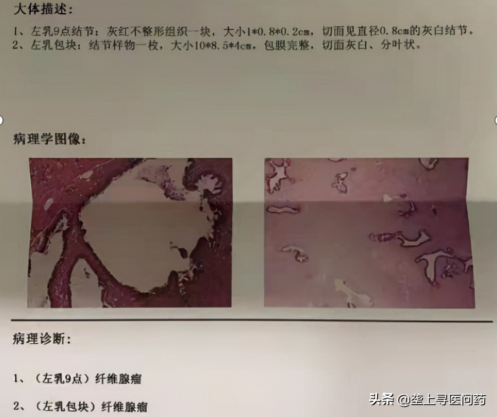 年轻女生胸部有肿瘤是啥原因,52岁女士胸部长个小瘤子越来越大