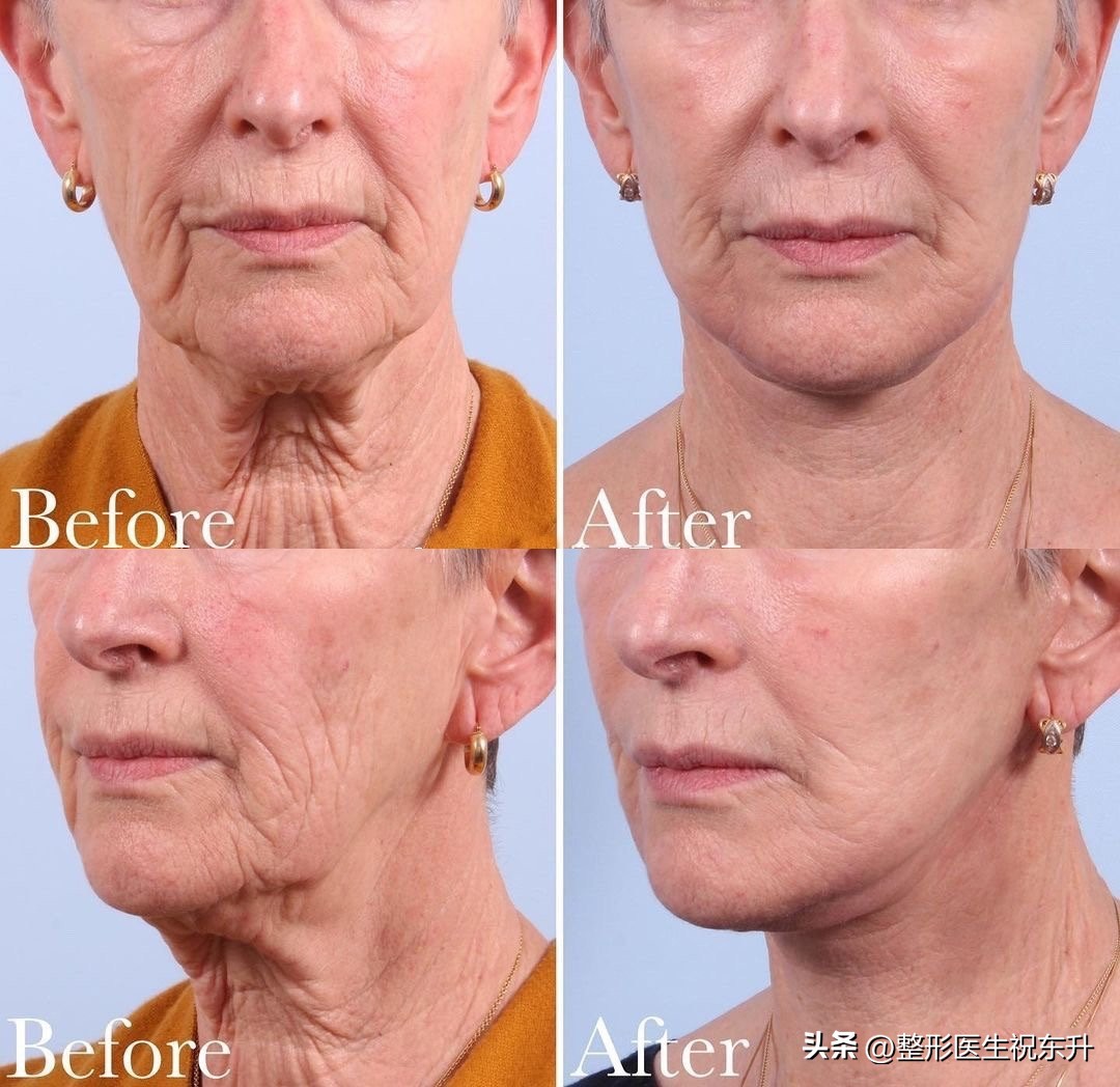 不让颈纹出卖年龄3招有效防颈纹,颈纹太深了怎么消除